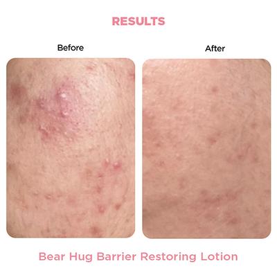 Resolve Bear Hug Barrier Restoring Lotion Fragrance Free 50 gm - Face Moisturizers