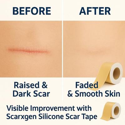Scarxgen Silicone Gel Sheet (4cm x 150cm) 1 's - Bandages & Dressings