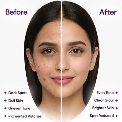 Kozilite H Cream 20gm - Dry Skin-Emo