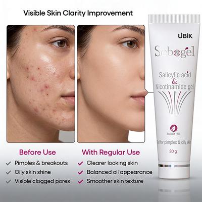 Sebogel Gel 30gm - Acne-Acn