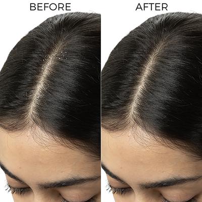 Brillare Tea Tree Oil For Itchy, Flaky, Dandruff Prone Scalp 100 ml - Hair Oils