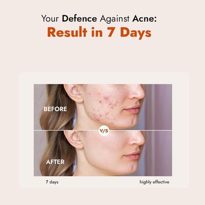 Alziba Cares Face Wash - Acne Care 100 ml - Face Washes