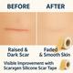 Scarxgen Silicone Gel Sheet (4cm x 150cm) 1 's - Bandages & Dressings