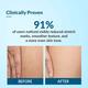 Fixderma Strallium Stretch Mark Cream 75 gm - Stretch Mark Cream