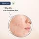 Fixderma Salyzap Acne kit 150 gm - Lotions & Creams