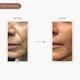 Dromen and Co Lifting and Firming Undereye and Cheek Strips 1's - Sheet Masks