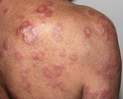 Leprosy