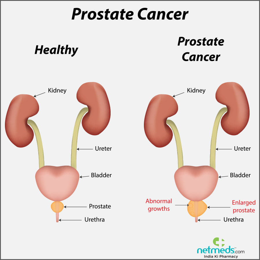 prostate cancer