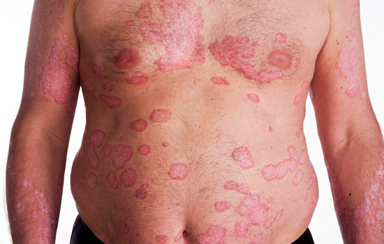 psoriasis-symptoms-and-signs
