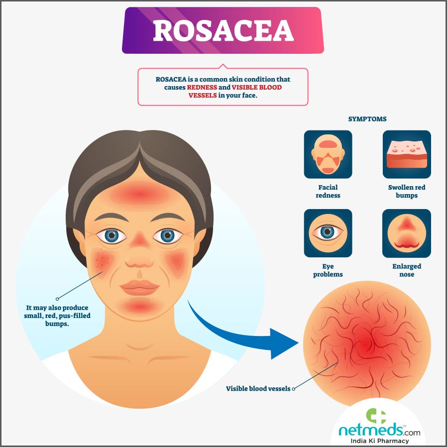 rosacea