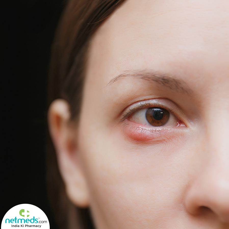 Stye