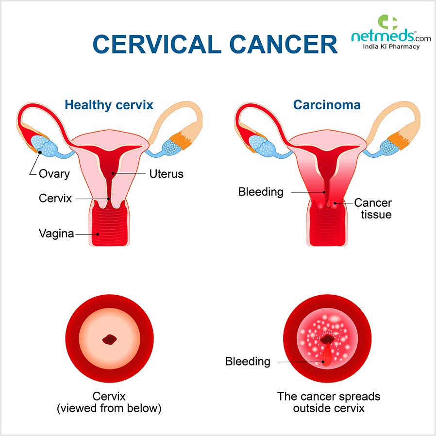 cervical cancer sypmtoms
