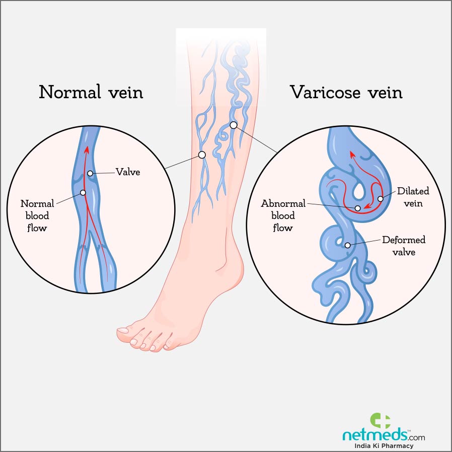 varicose veins symptoms