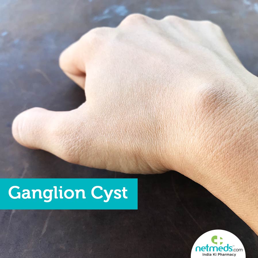 Cyst near joints